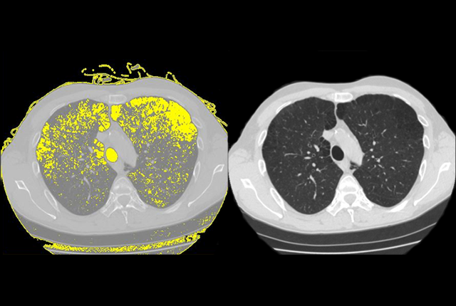 Lung Tissue