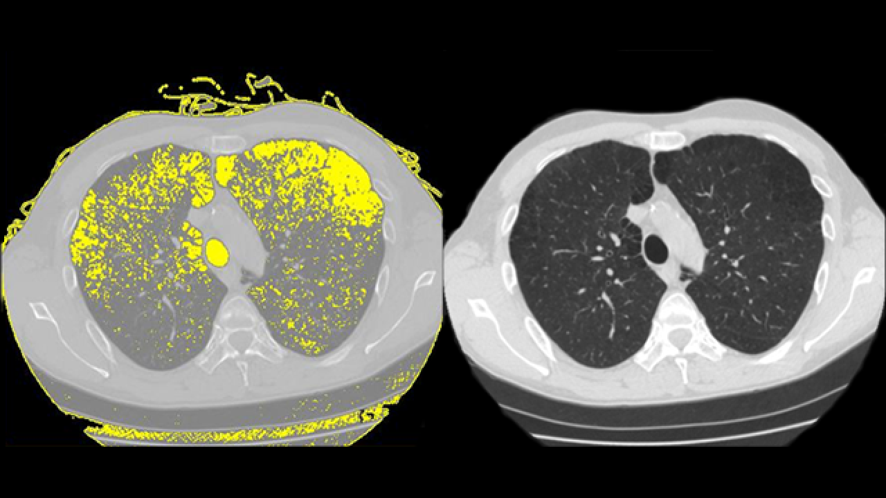 chest CT scan 